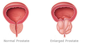 enlargedprostate